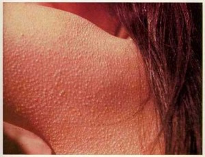 keratosis-pilaris